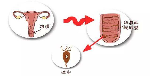 滴蟲性陰道炎