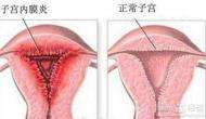 子宮內(nèi)膜炎