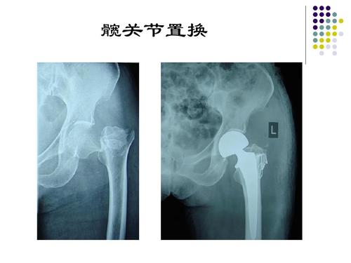髖關節置換術