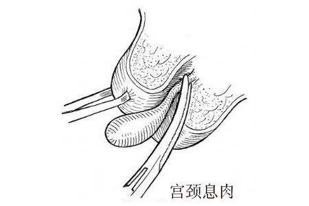 子宮頸息肉